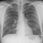 Positive Lifestyle Changes for COPD
