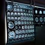 Is Your Brain Secretly Aging Too Fast? One Scan Could Reveal the Truth
